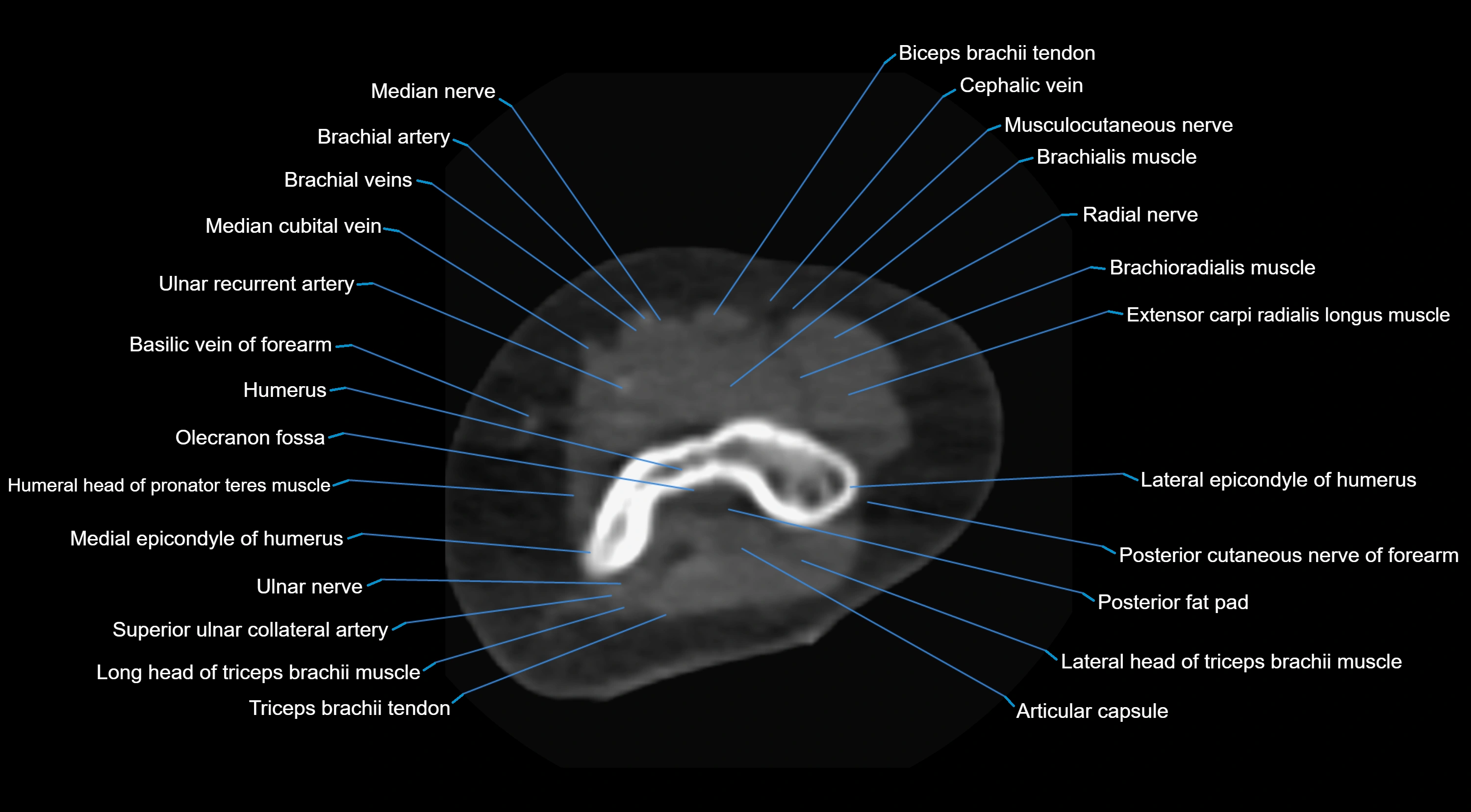 CT elbow axial  cross sectional anatomy labelled  radiology image -00014.webp